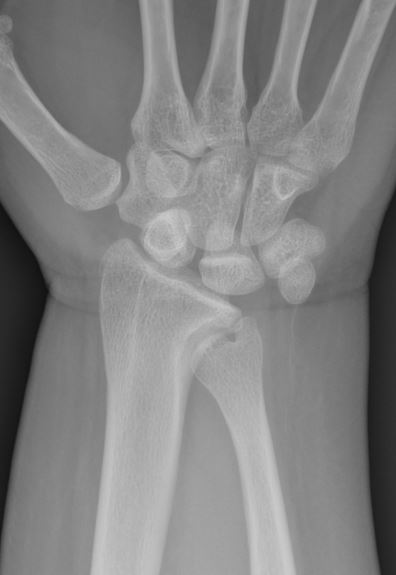 Figure 2 for case ulnar impingement syndrome